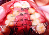 Expansion of Upper Jaw