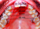 Expansion of Upper Jaw